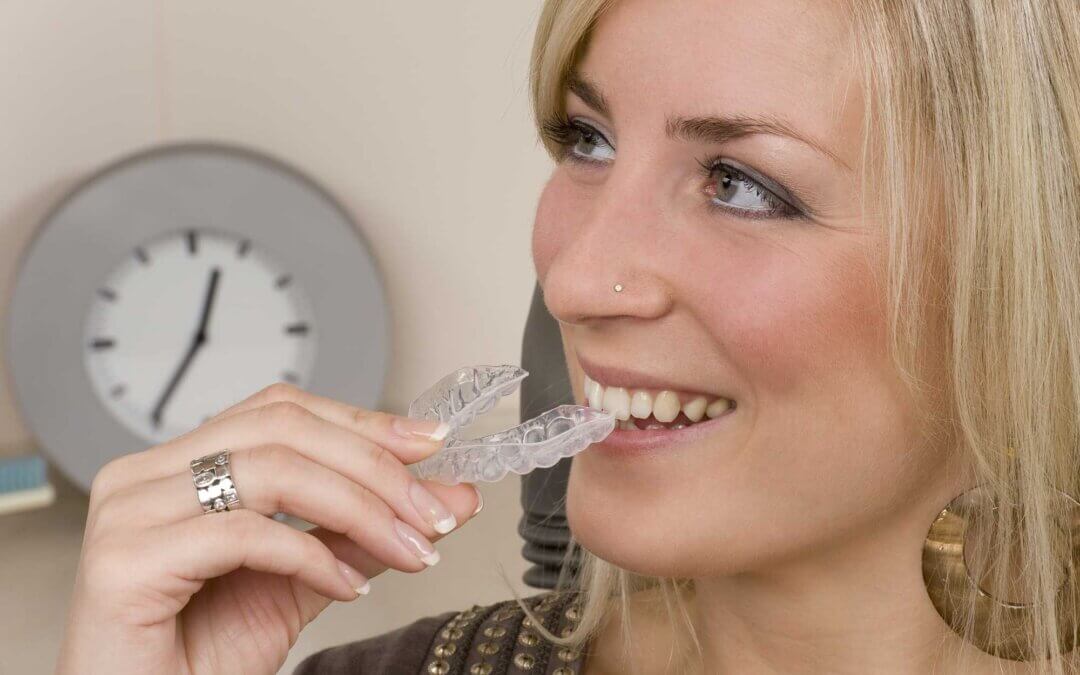 How to Select an Invisalign Dentist: Everything You Need to Know